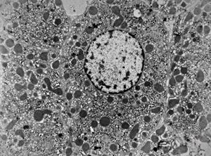 M,3y. | normal hepatocyte M,3y. | normal hepatocyte